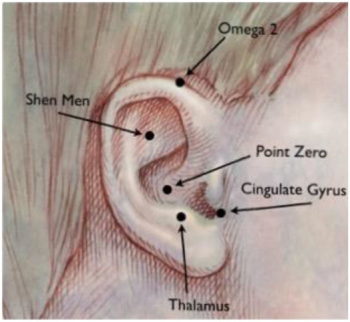 DVCIPM, Battlefield Acupuncture image